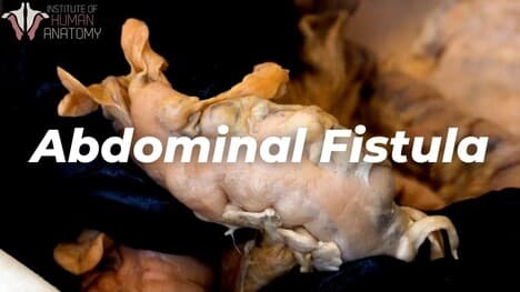 Abdominal Fistula Explained: The Scariest Complication of Abdominal Surgery