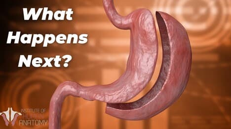 Removing 80% of the Stomach