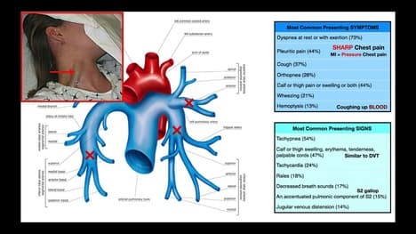 Wells Criteria for Pulmonary Embolisms [PEs] EXPLAINED