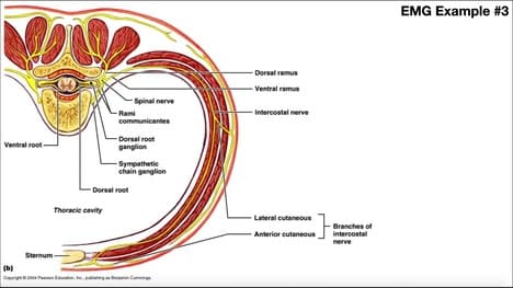 Diagnosing Nerve Damage with EMG [Example 1] | UE, Proximal to Elbow