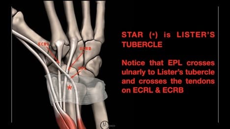 Wrist Extensor Zones EXPLAINED