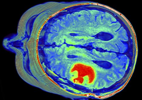 Tumours: The Kill or Cure Virus