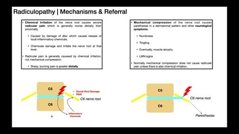 Radicular Pain Versus Radiculopathies EXPLAINED