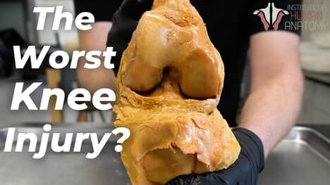 The Worst Possible Direction for Knee Joint: Hyperextension