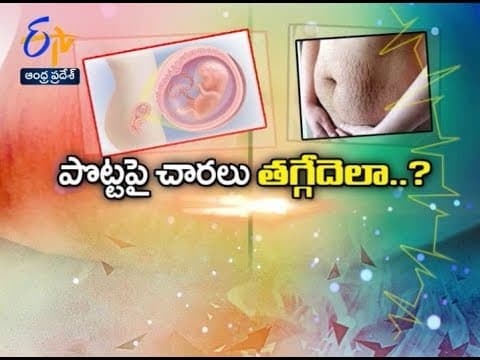 Scars after delivery and treatments