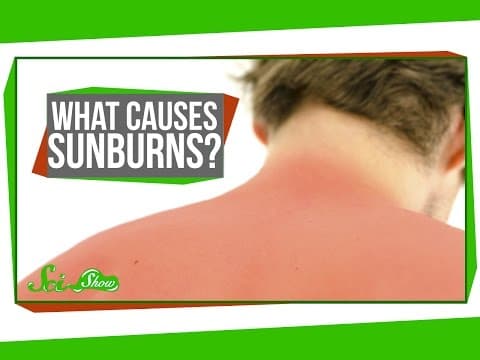 What Causes Sunburns?
