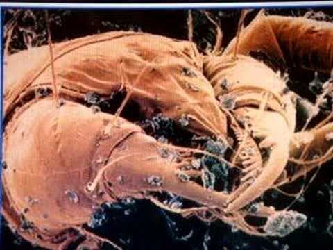 Allergies-Hypersensitivity Type 1 - YouTube