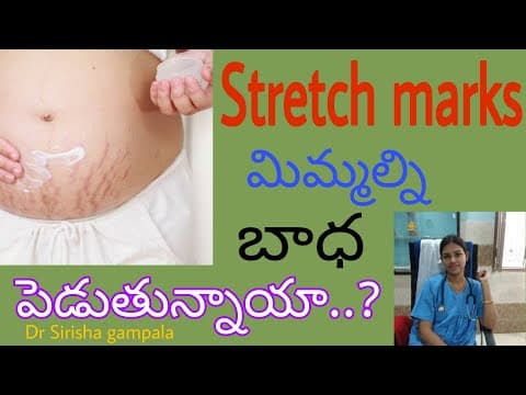 గర్భిణీలకు Stretch marks రాకుండా natural గా||Stretch marks in pregnancy