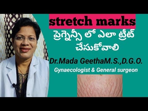 Stretch marks during pregnancy - - how to prevent & treat after pregnancy
