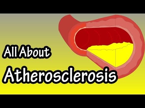 Atherosclerossis Explained - What Is Atherosclerosis - What Is Artery Plaque