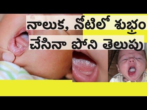 నోటిలో పలు భాగాల్లో నాలుకపై తెల్లటి పూత ( ఓరల్ త్రష్ )
