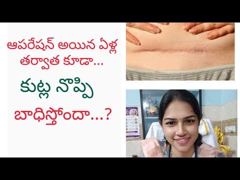 సిజేరియన్ అయ్యి ఎన్ని ఏళ్ళయినా కుట్లు నొప్పి తగ్గడం లేదా ..? cesarean scar pain after years...