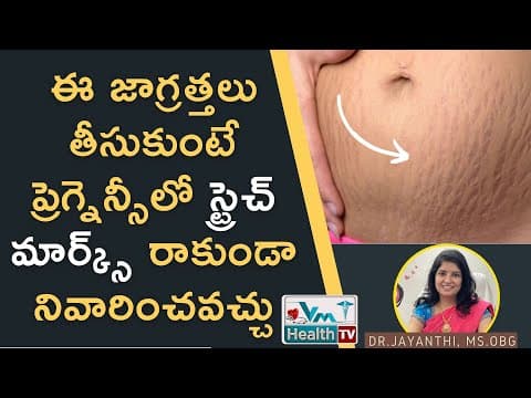 పొట్టపై చారలు రాకుండా ఉండాలంటే ఇలా చేయండి | How To Avoid Stretch Marks In Pregnancy