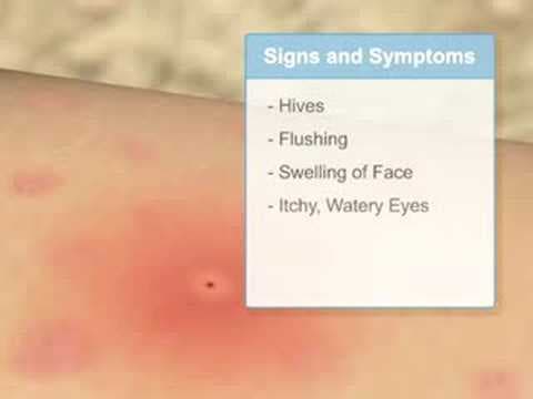 Anaphylactic allergic reaction - YouTube