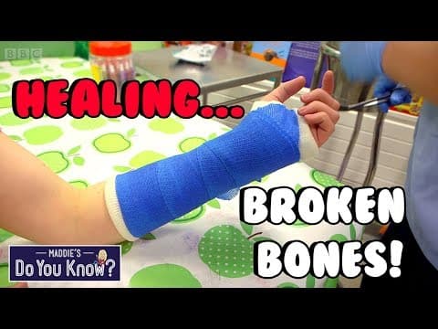 How are casts made to heal broken bones