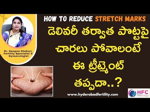 డెలివరీ తర్వాత వచ్చే స్ట్రెచ్‌మార్క్స్‌ తగ్గాలంటే - how to reduce stretch marks after delivery