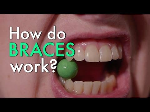 How do braces work