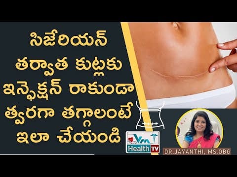 సిజేరియన్ కుట్లకు ఎలాంటి జాగ్రత్తలు తప్పనిసరి | Stitches Care After C Section | Vm Health Tv