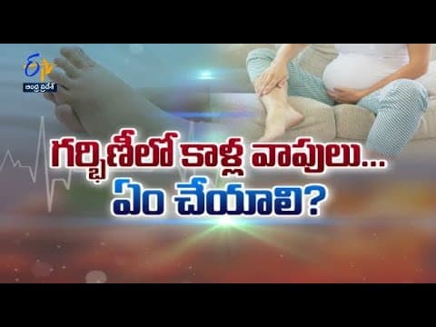 Leg edema during pregnancy